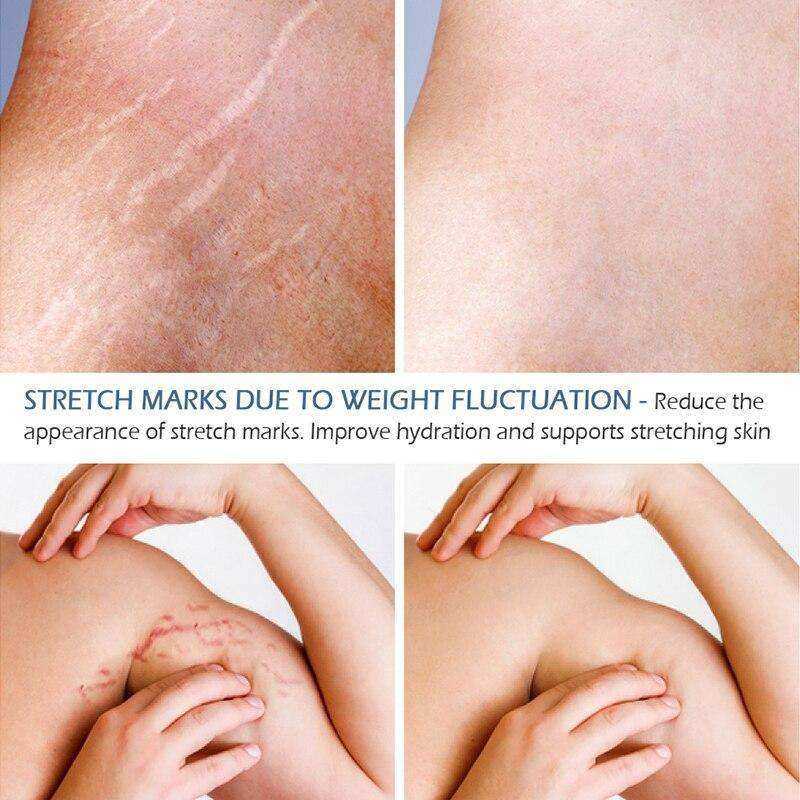 Crocodile Stretch Marks Remover Body Repair Cream