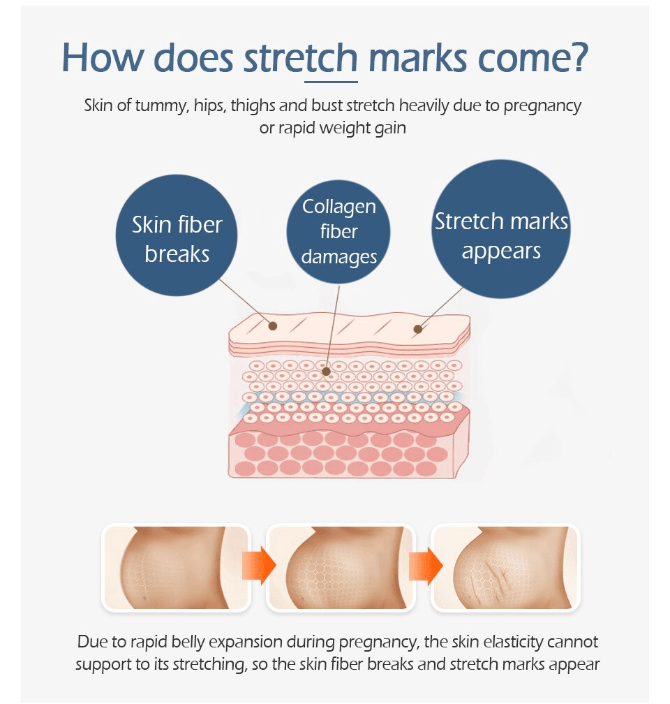 Crocodile Stretch Marks Remover Body Repair Cream