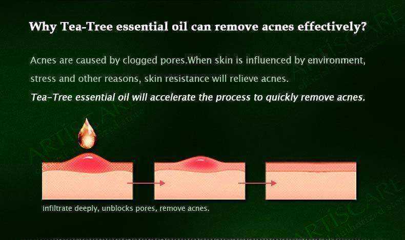 Health - Powerful Acne Remover 100% Pure Tea Tree Essential Oil