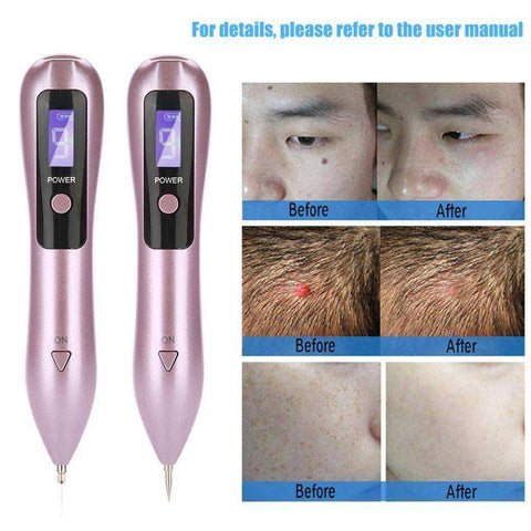 Image of 9 Level Laser Plasma Pen Skin Dark Spot Remover