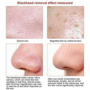 Visible Camera Face Deep Nose Blackhead Pore Acne Pimple Remover