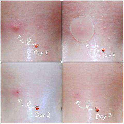 Image of Beauty Face Spot Scar Acne Pimple Master Patch