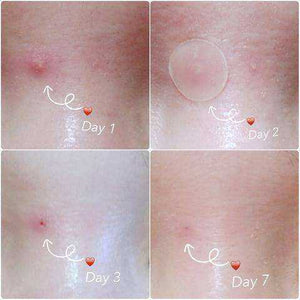 Beauty Face Spot Scar Acne Pimple Master Patch