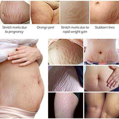 Crocodile Stretch Marks Cream Remove Pregnancy Scars