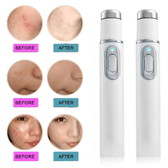 Heath Blue Light Therapy Wrinkle Acne Laser Pen