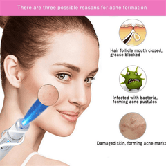 Heath Blue Light Therapy Wrinkle Acne Laser Pen