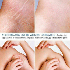 Crocodile Stretch Marks Cream Remove Pregnancy Scars