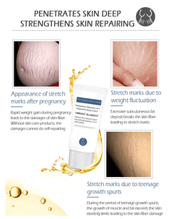 Crocodile Stretch Marks Cream Remove Pregnancy Scars