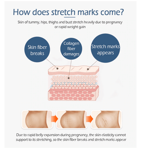 Crocodile Stretch Marks Cream Remove Pregnancy Scars