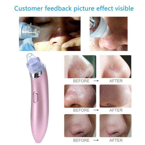 Image of Black Dots Extractor Comedo Suction Pore Vacuum Cleaner