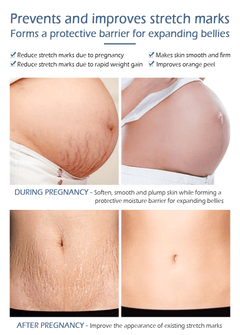 Crocodile Stretch Marks Remover Body Repair Cream