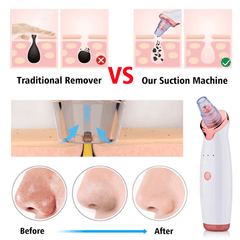 Electric Cleanser Facial Blackhead Remover Vacuum Suction