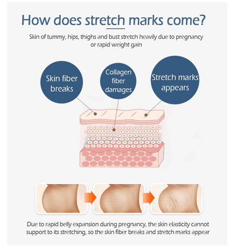 Image of Crocodile Stretch Marks Remover Body Repair Cream