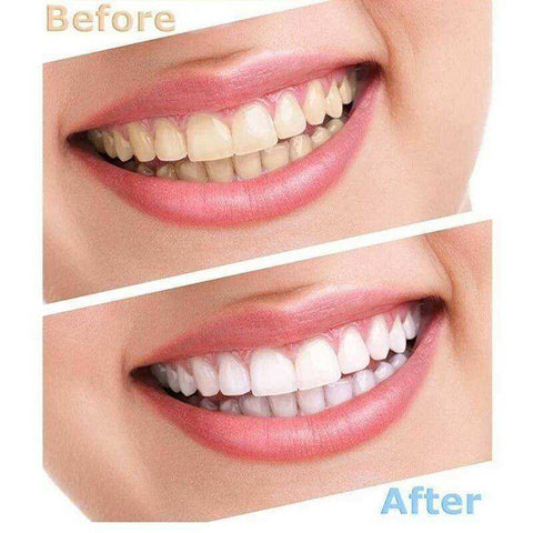 Professional Quality Peroxide Teeth Whitening Kit With LED Light
