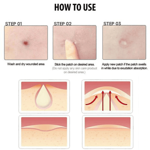 Image of Hydrocolloid Acne Patch Pimple Stickers